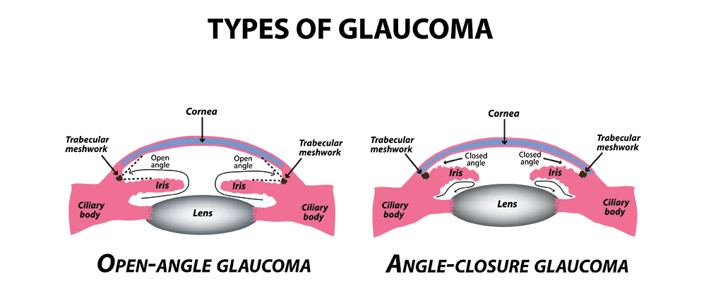 Illustration of open-angle and angle-closure glaucoma