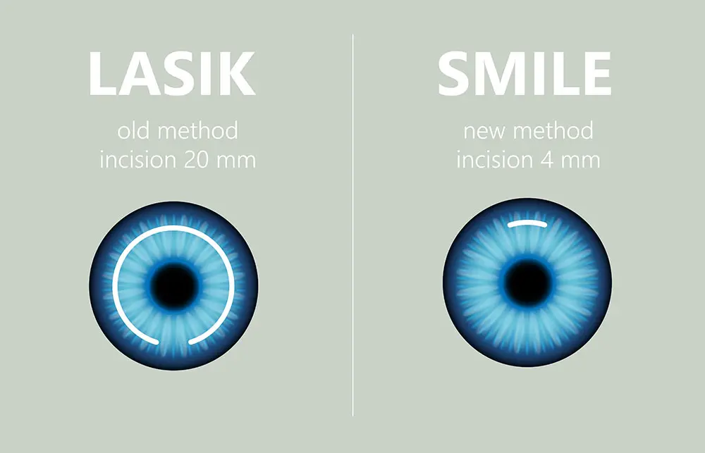 Comparison Close-up eye of laser eye surgery of old and new method LASIK and SMILE